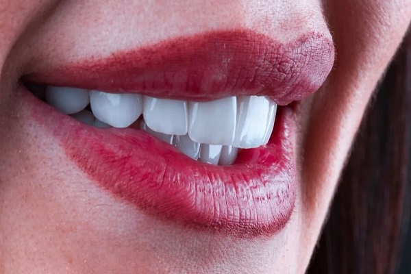 4----hollywood-smile